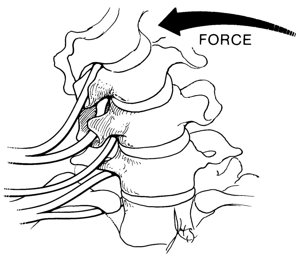 bending stress on spine showing anterior compression and posterior tension on spinal discs