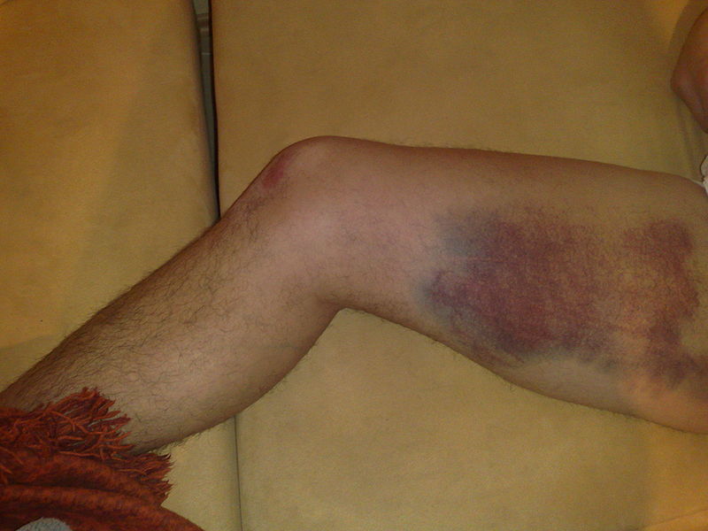 severe grade 2 or 3 muscle strain